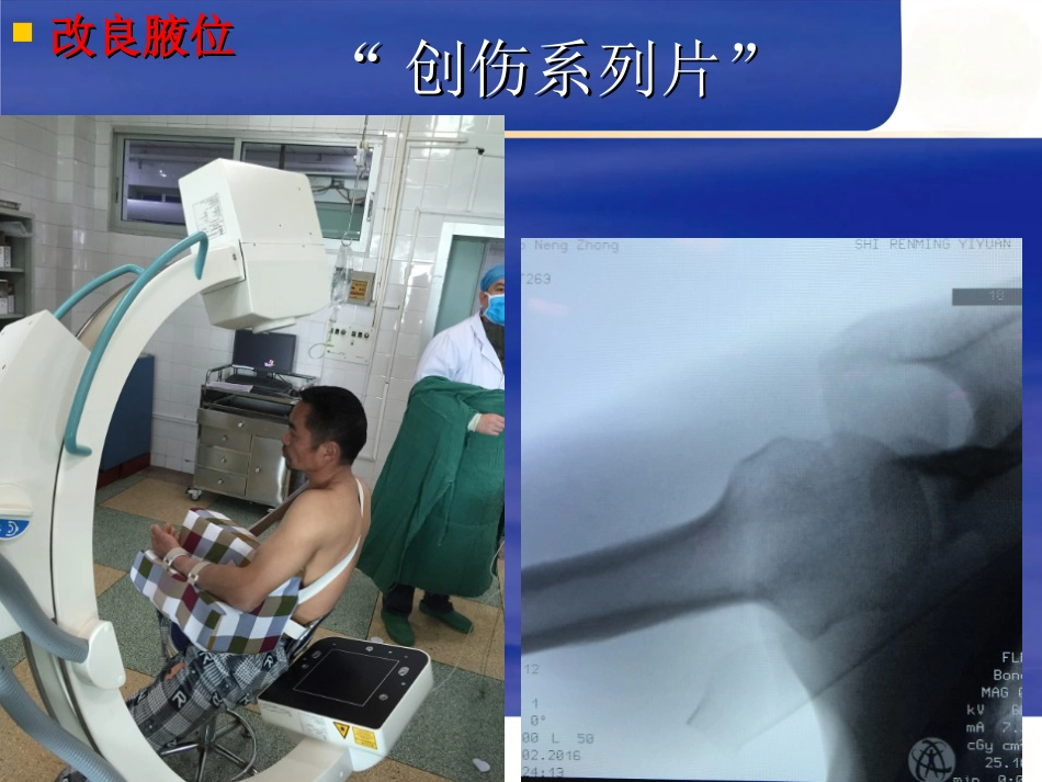 肱骨近端骨折Neer分型及治疗_第8页