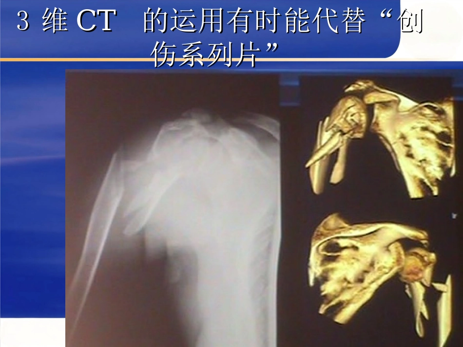 肱骨近端骨折Neer分型及治疗_第9页