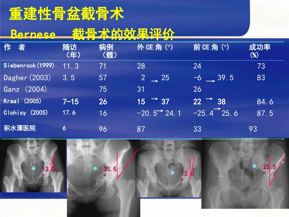 成人髋关节发育不良的手术选择_第12页