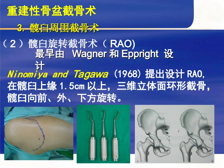 成人髋关节发育不良的手术选择_第13页
