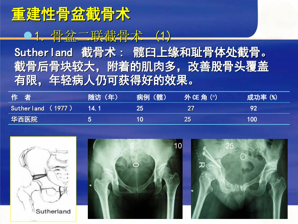 成人髋关节发育不良的手术选择_第5页