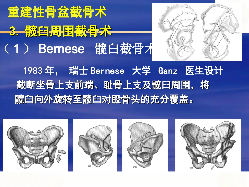 成人髋关节发育不良的手术选择_第9页