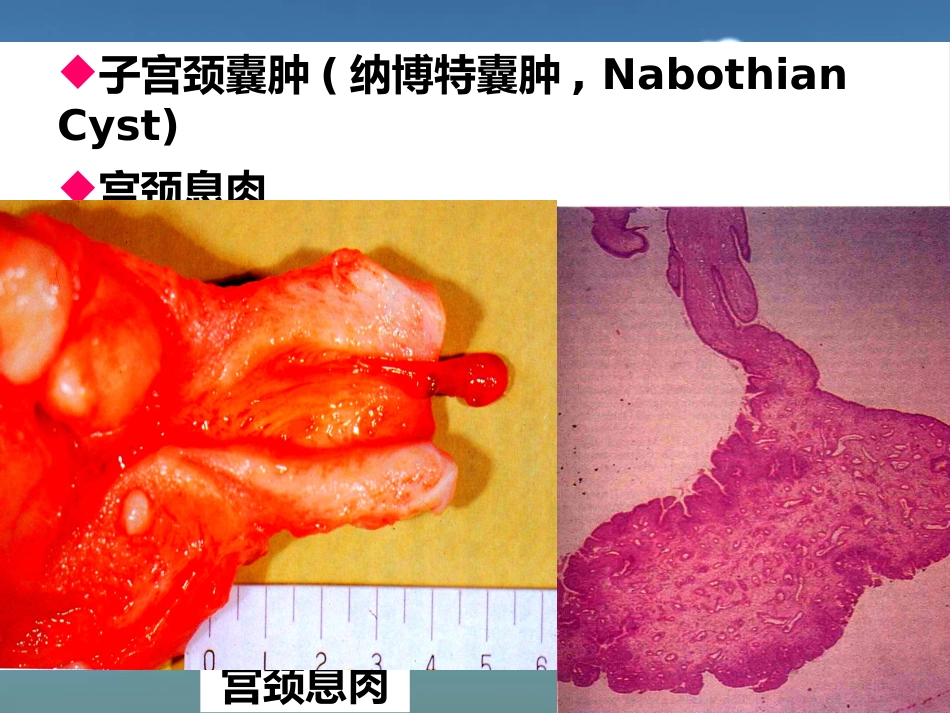 病理学13生殖系统和乳腺疾病_第10页