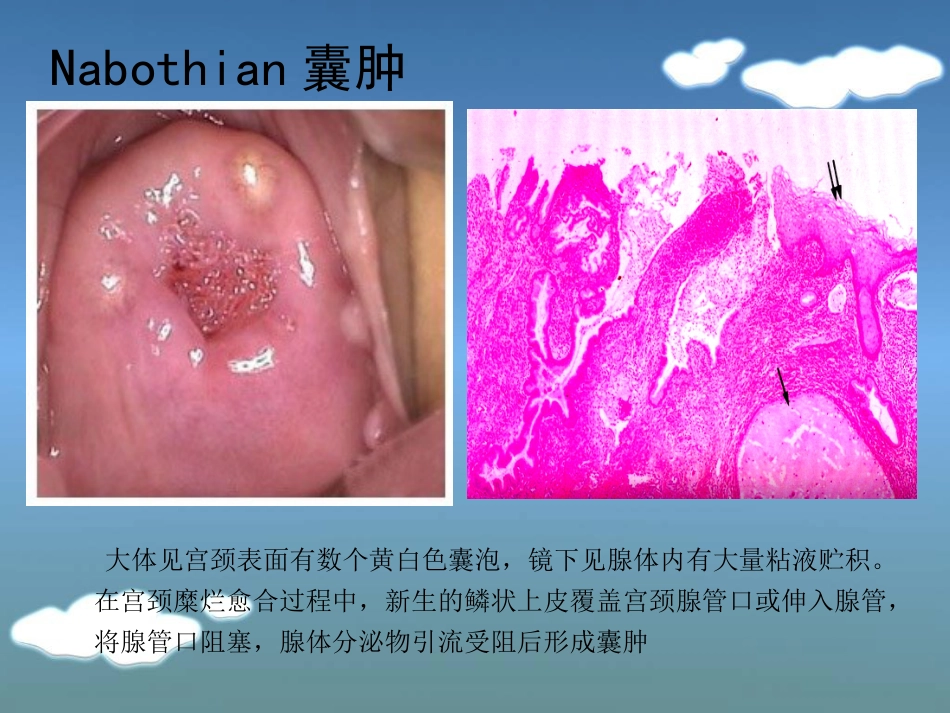 病理学13生殖系统和乳腺疾病_第11页