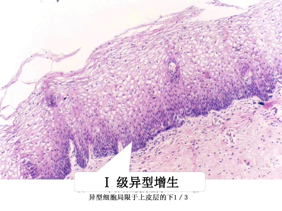 病理学13生殖系统和乳腺疾病_第14页