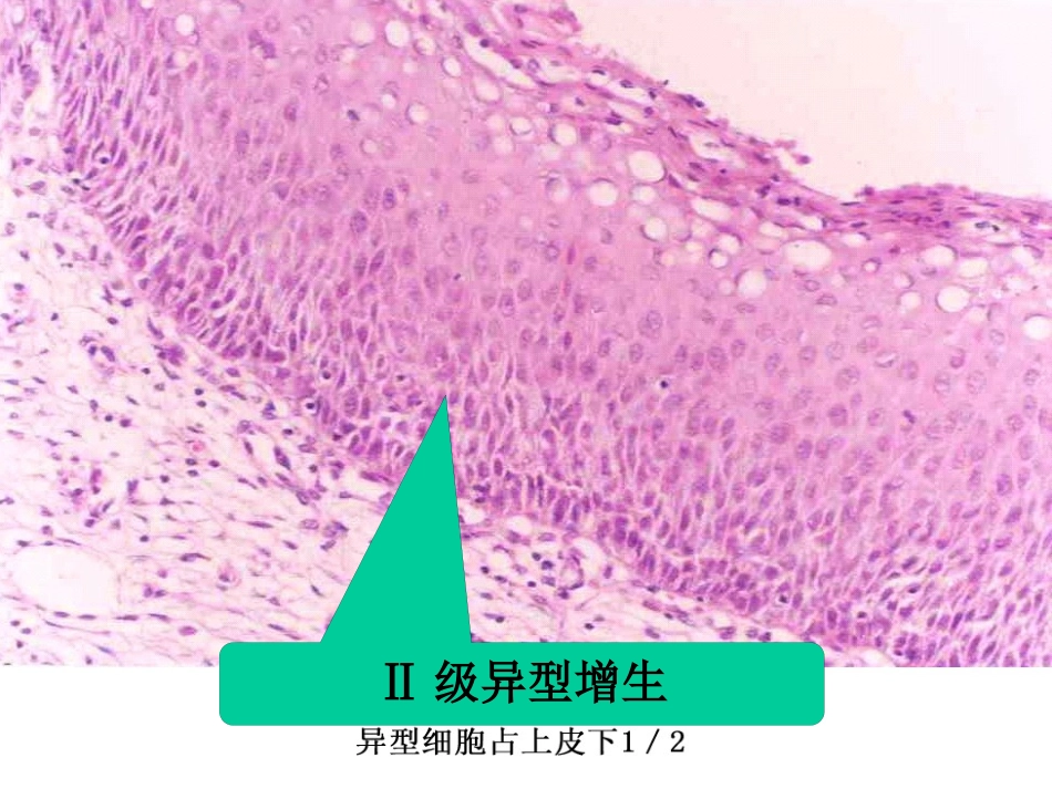 病理学13生殖系统和乳腺疾病_第15页