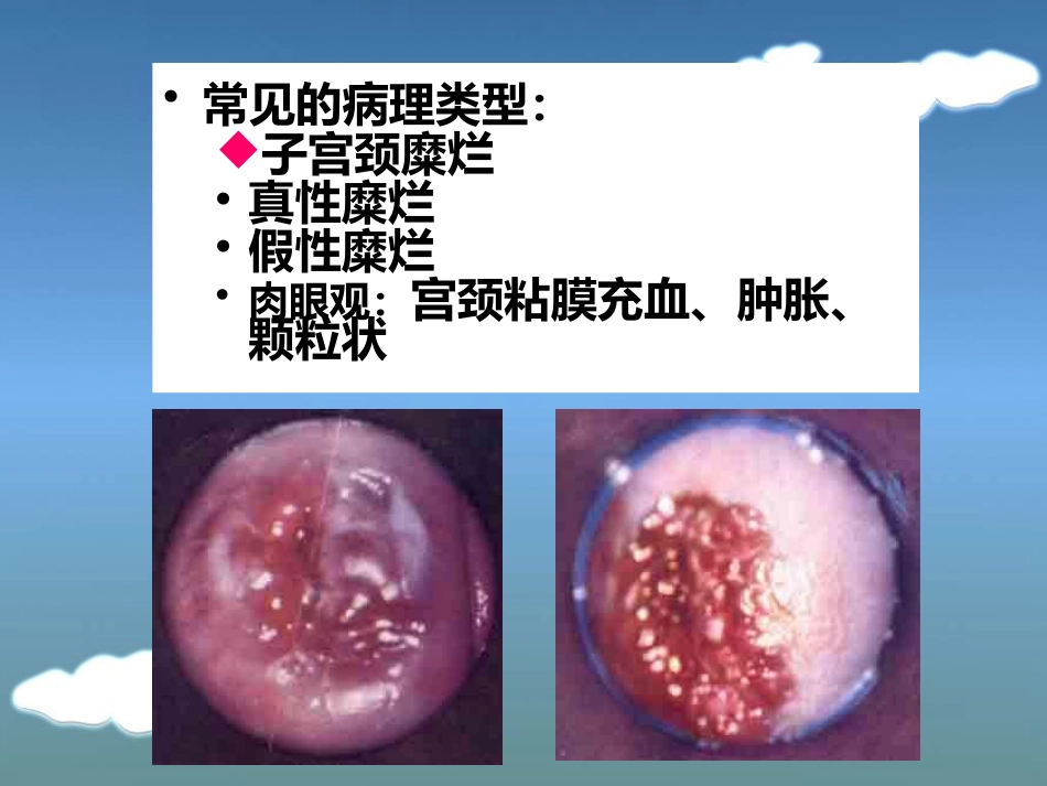 病理学13生殖系统和乳腺疾病_第9页