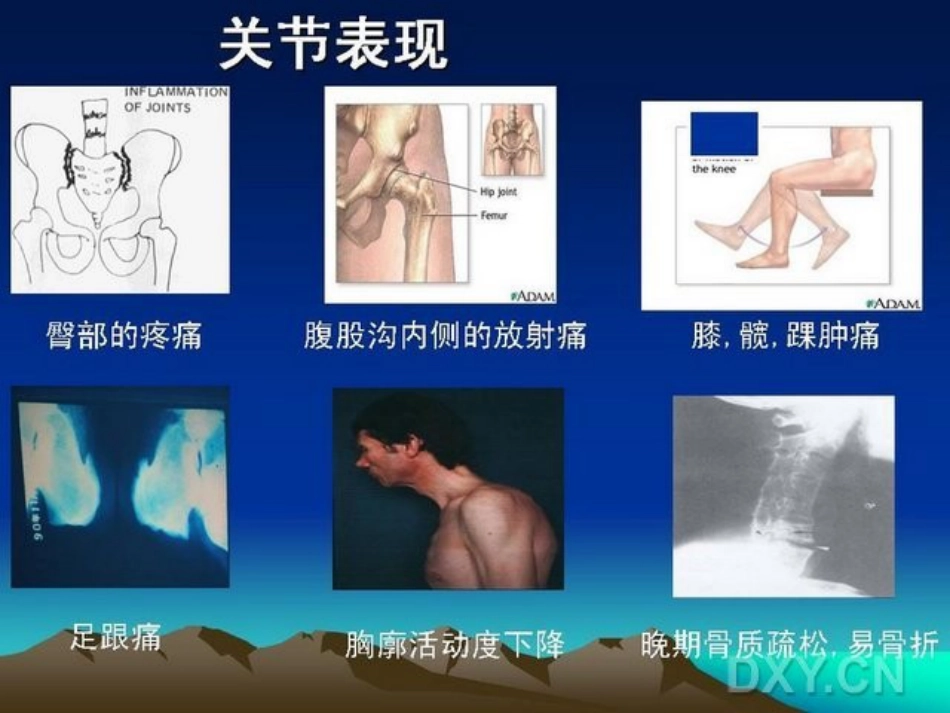 骨科-强直性脊柱炎_第13页