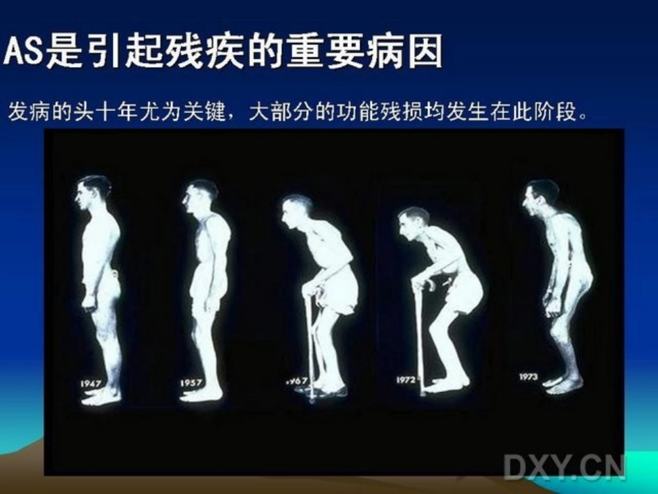 骨科-强直性脊柱炎_第5页