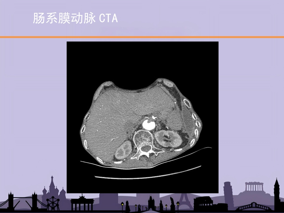 老年病年会缺血性肠病_第15页