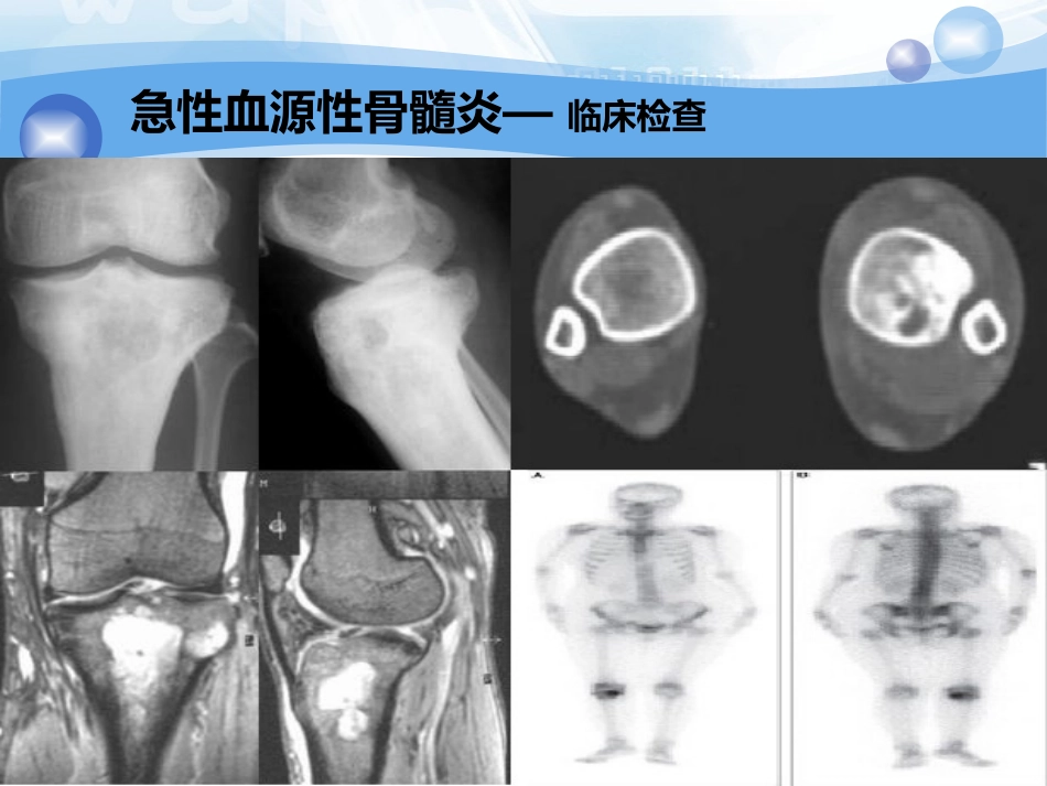 骨科-骨与关节化脓性感染、结核_第13页
