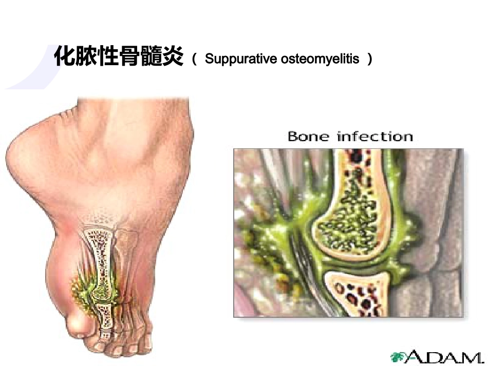 骨科-骨与关节化脓性感染、结核_第4页