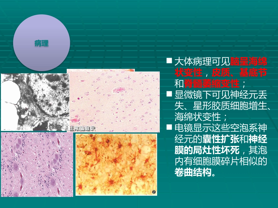 CJD临床诊断_第12页