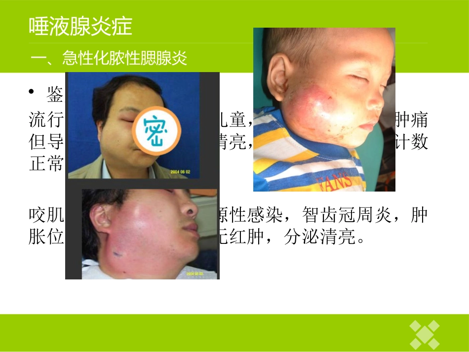 高校临床医学课件唾液腺常见疾病_第7页