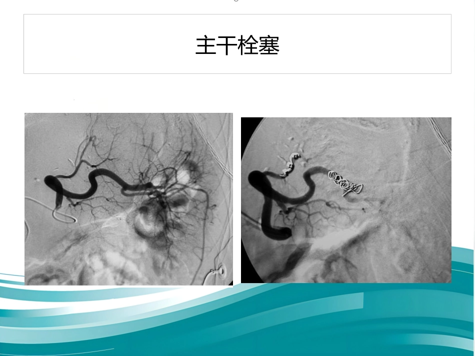 部分脾动脉栓塞的临床应用_第7页