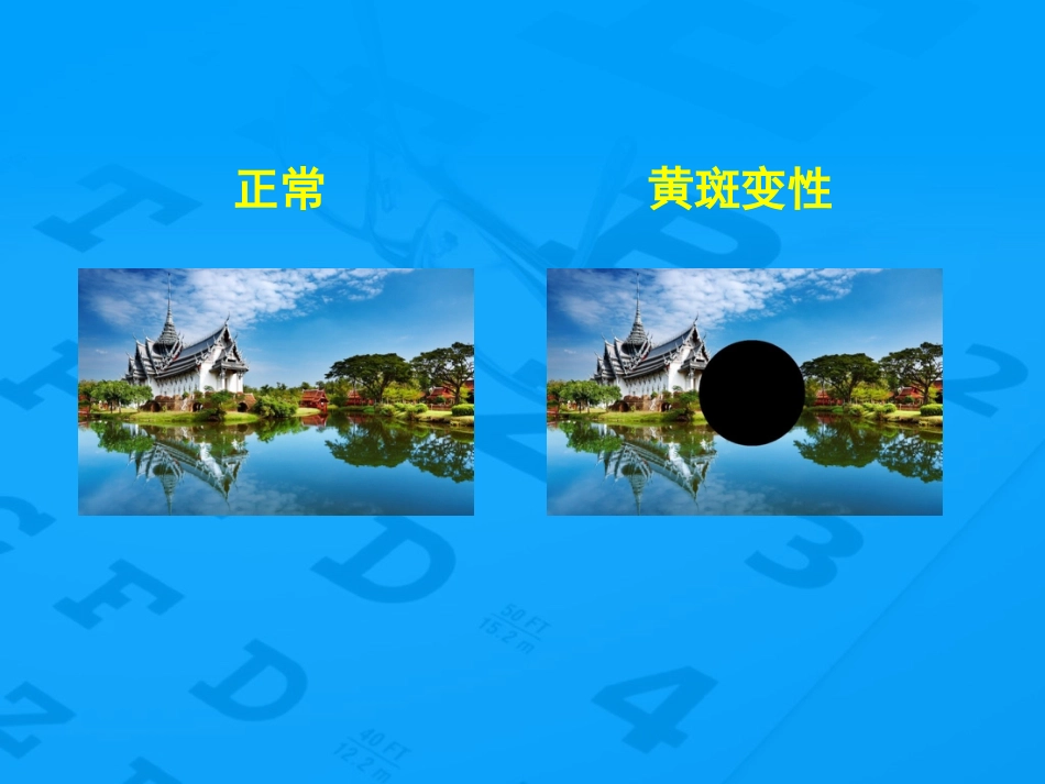 老年性黄斑变性防治_第12页