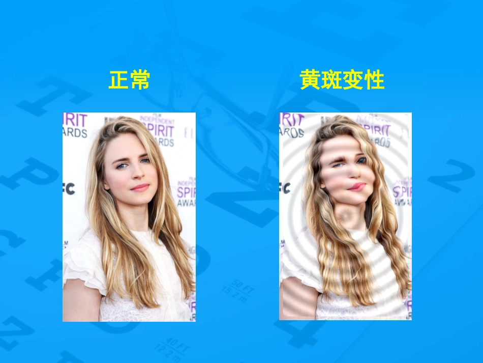 老年性黄斑变性防治_第13页