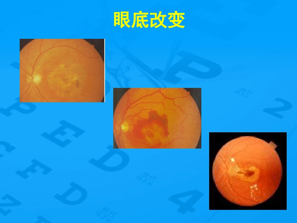 老年性黄斑变性防治_第14页