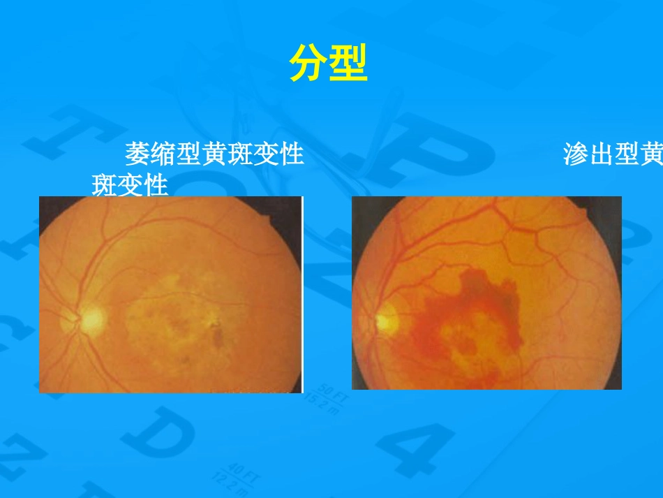 老年性黄斑变性防治_第9页