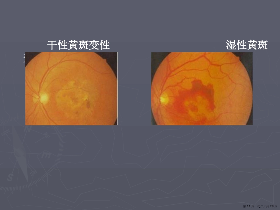 老年性黄斑变性课件课件_第11页