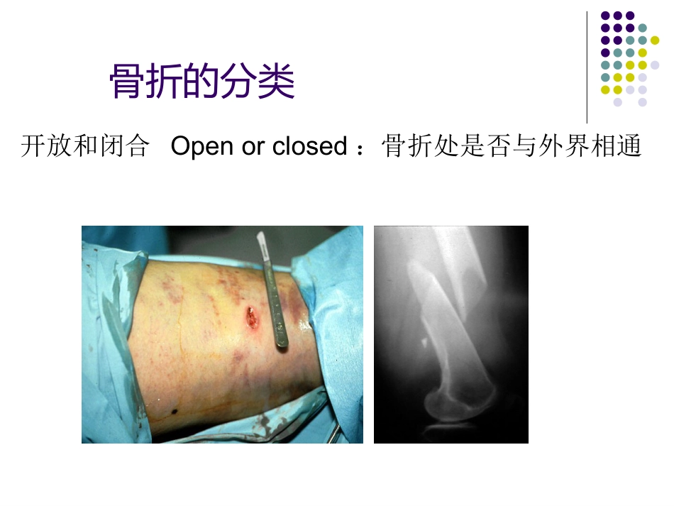 骨科-骨折总论-_第12页