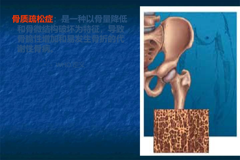 骨科-骨质疏松症ppt_第3页