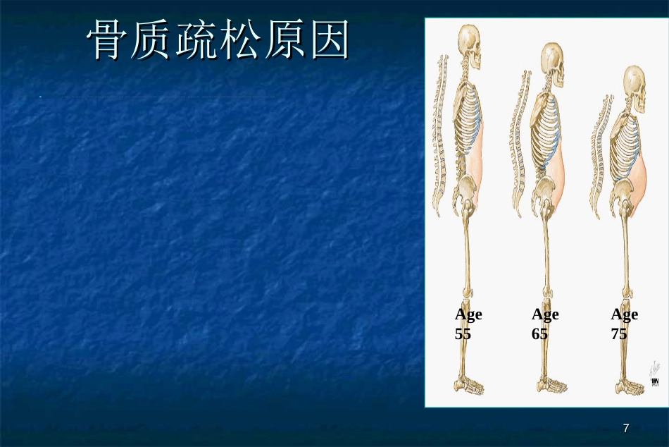 骨科-骨质疏松症ppt_第7页