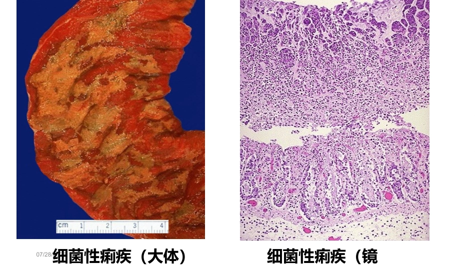 传染病 细菌性痢疾 病理学课件_第8页