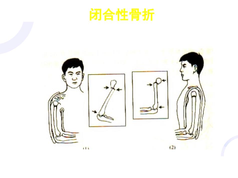 骨科-骨折概论（修改）_第11页