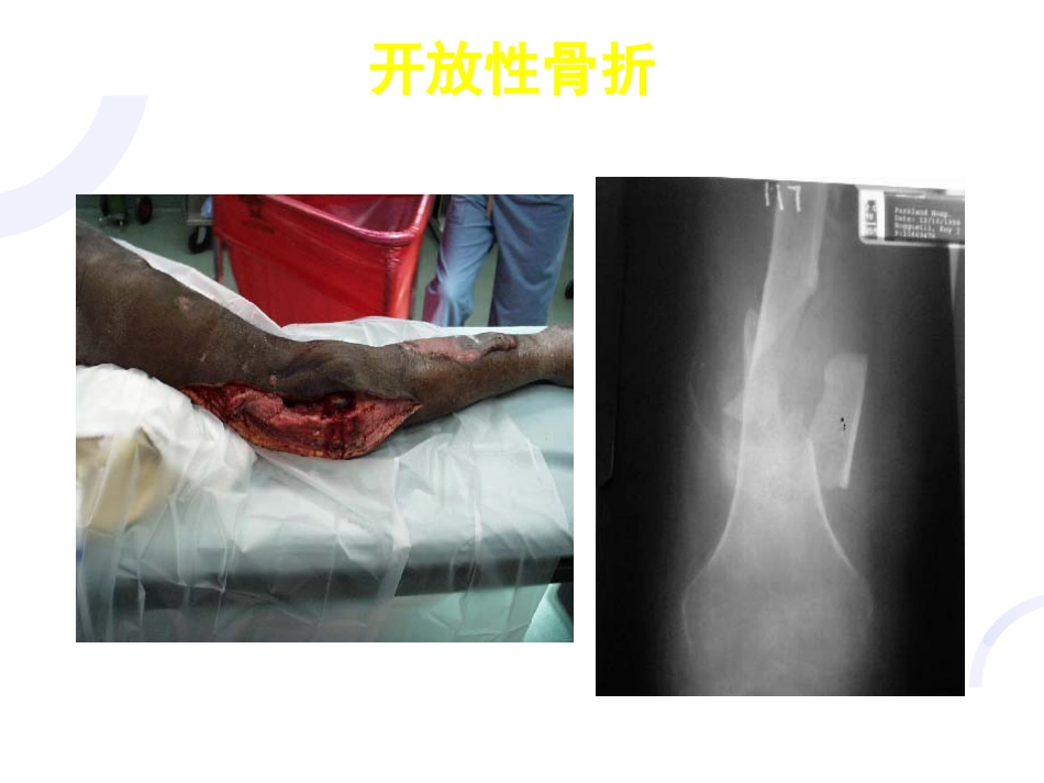 骨科-骨折概论（修改）_第12页