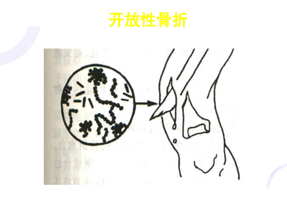 骨科-骨折概论（修改）_第14页