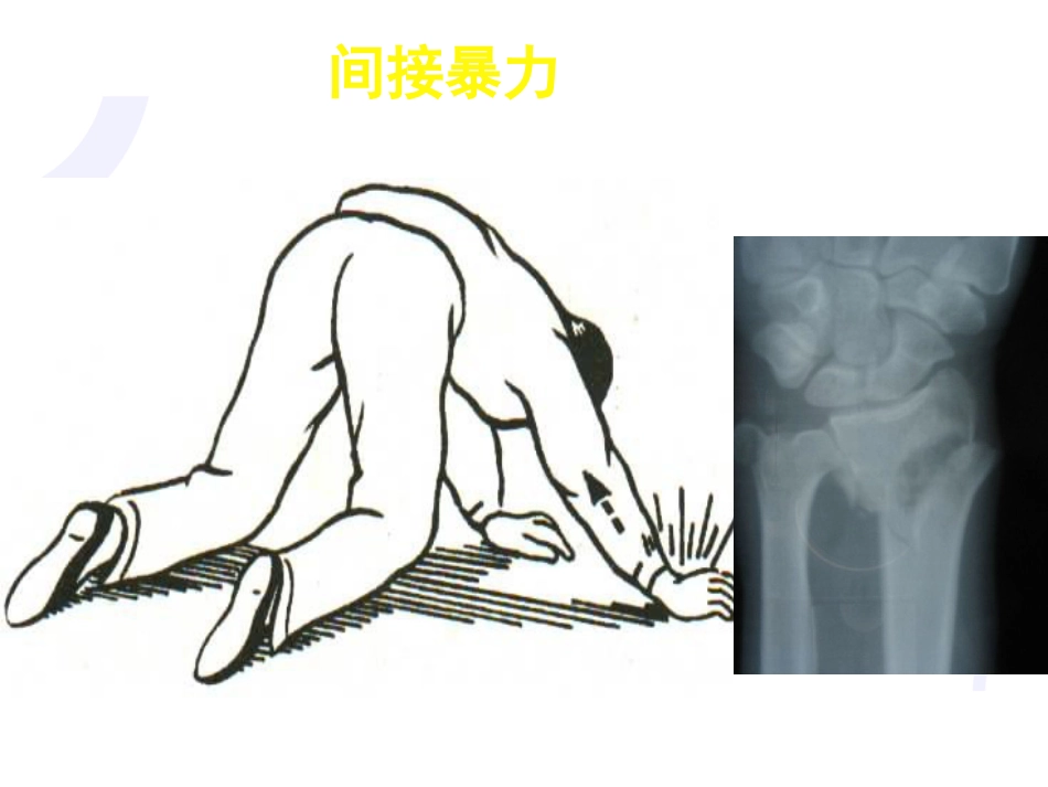 骨科-骨折概论（修改）_第6页