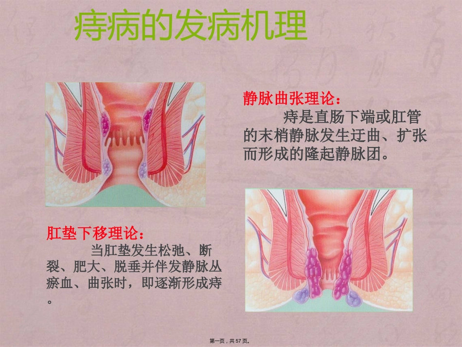 RPH治疗混合痔临床应用_第1页