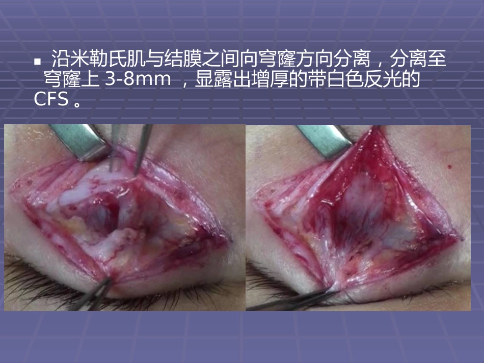 CFS+LM治疗先天性重度上睑下垂临床体会_第10页