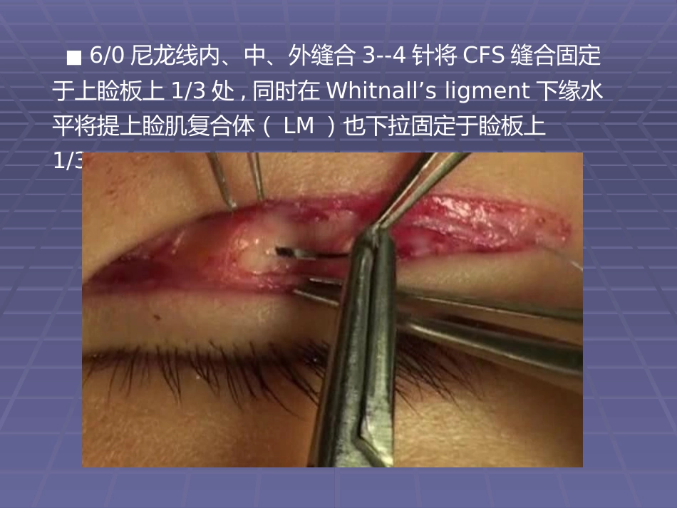 CFS+LM治疗先天性重度上睑下垂临床体会_第12页
