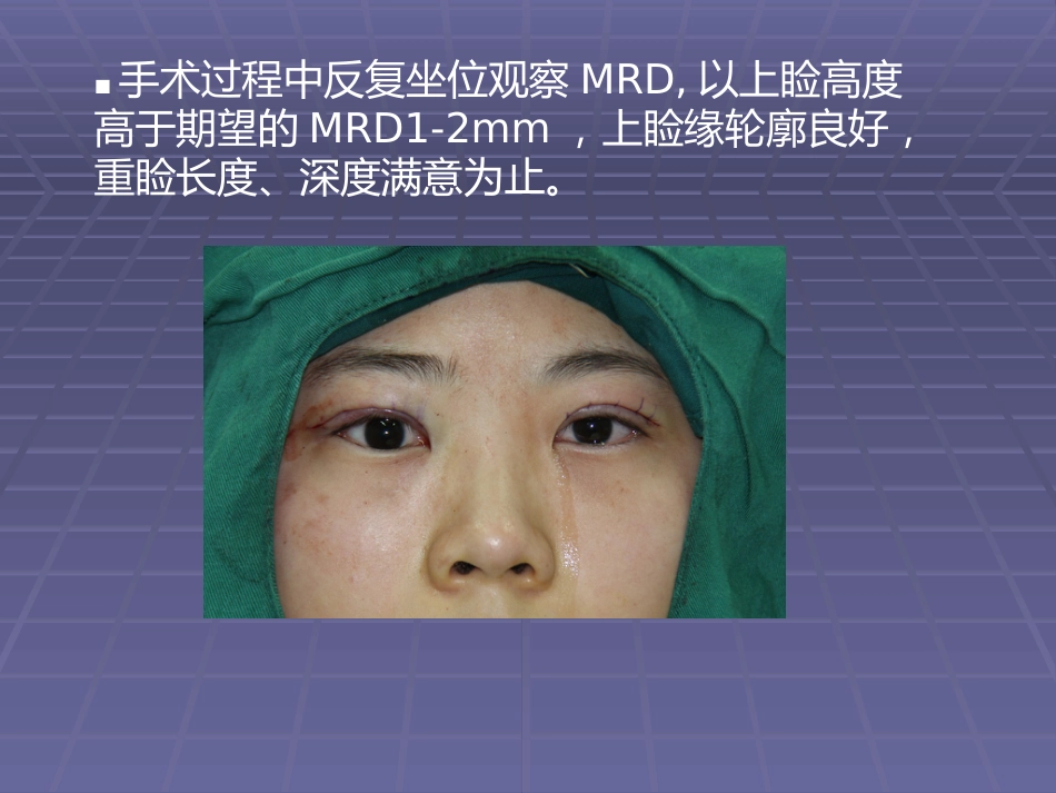 CFS+LM治疗先天性重度上睑下垂临床体会_第15页