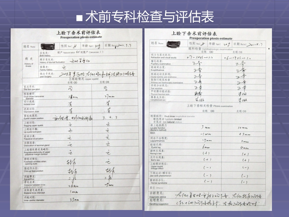 CFS+LM治疗先天性重度上睑下垂临床体会_第4页