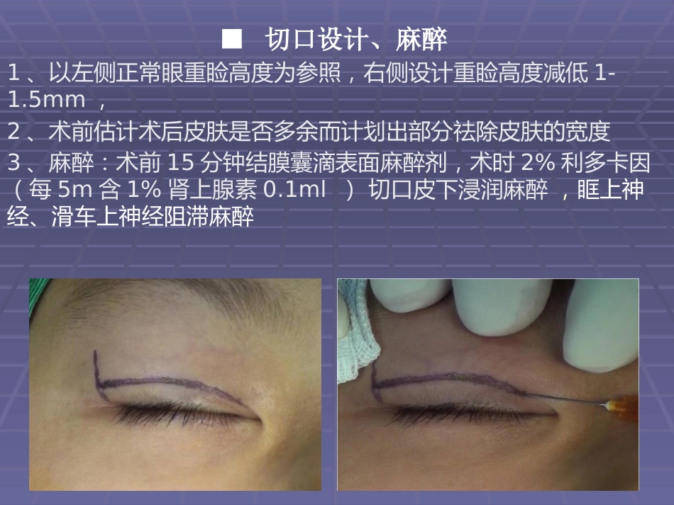 CFS+LM治疗先天性重度上睑下垂临床体会_第5页