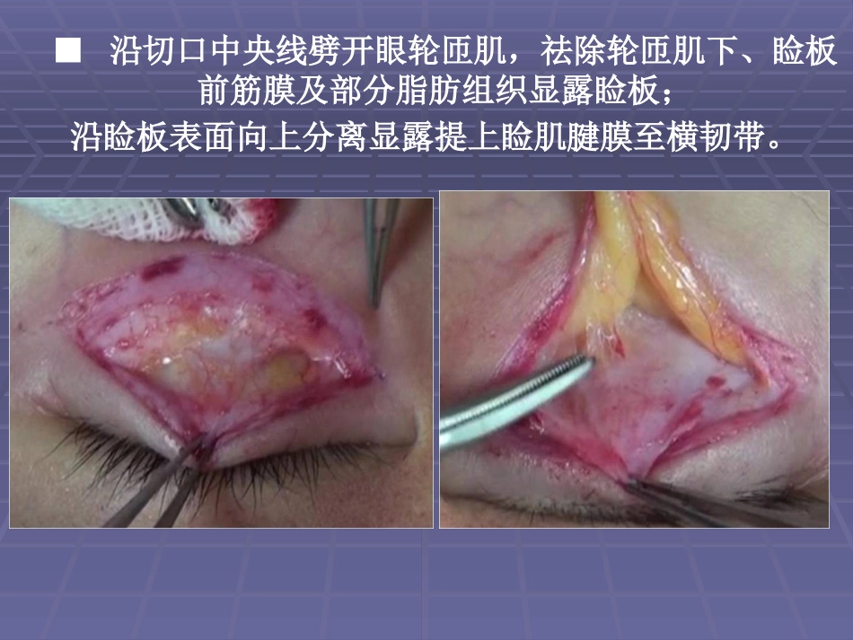 CFS+LM治疗先天性重度上睑下垂临床体会_第7页