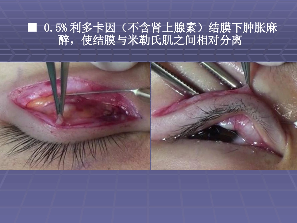 CFS+LM治疗先天性重度上睑下垂临床体会_第8页