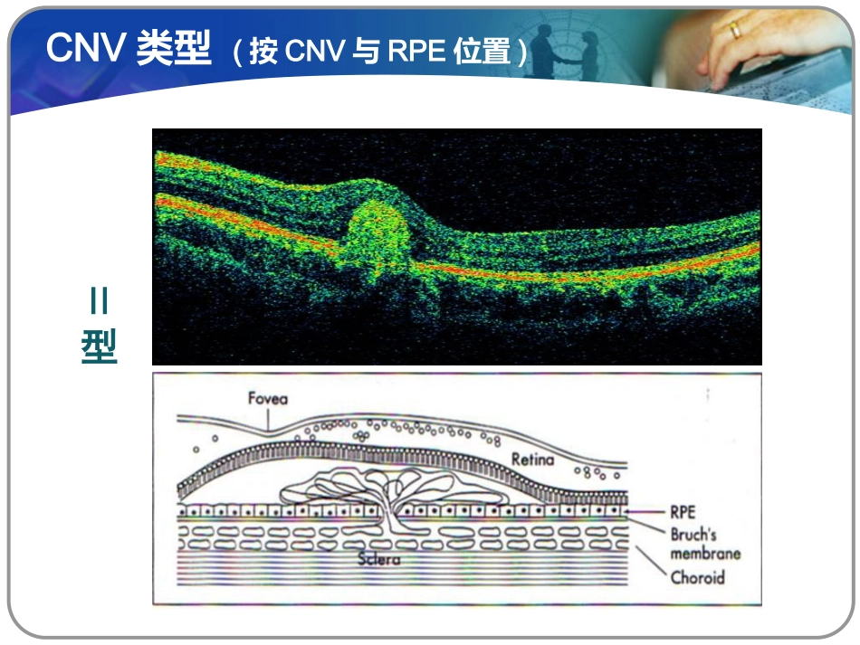 老年性黄斑变性课件_第13页
