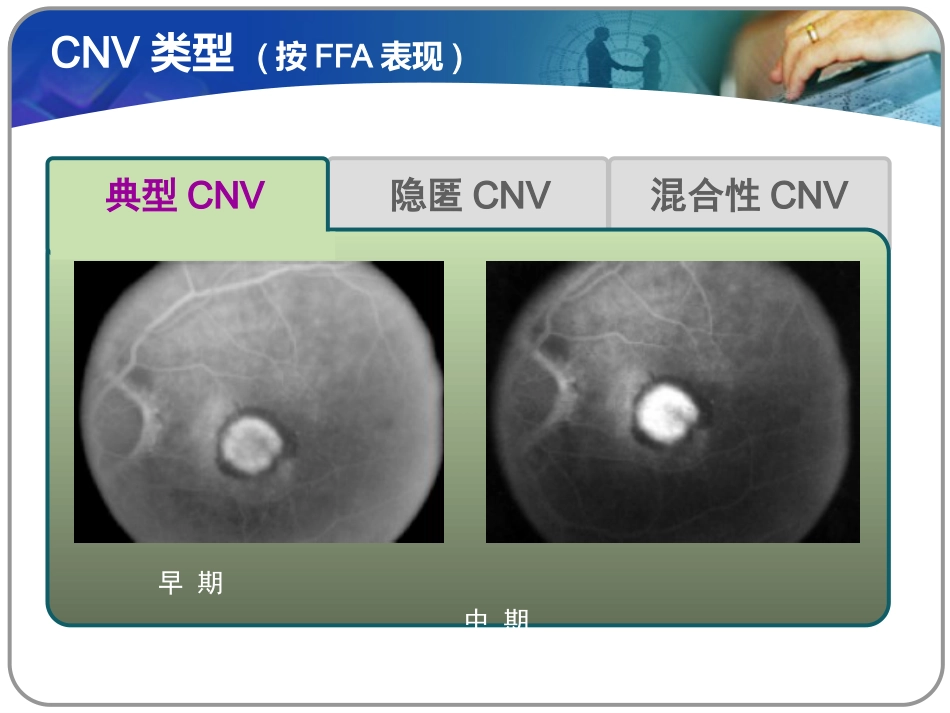 老年性黄斑变性课件_第15页