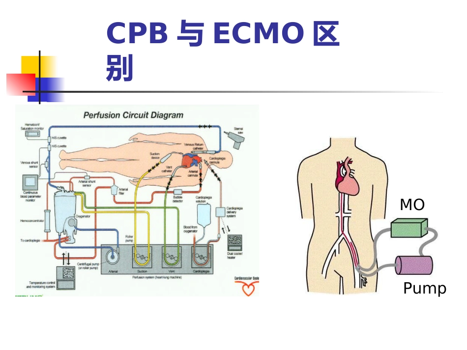ECMO的临床应用_第10页