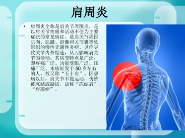 骨科-肩周炎