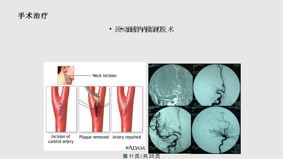 tia及临床路径PPT课件_第11页