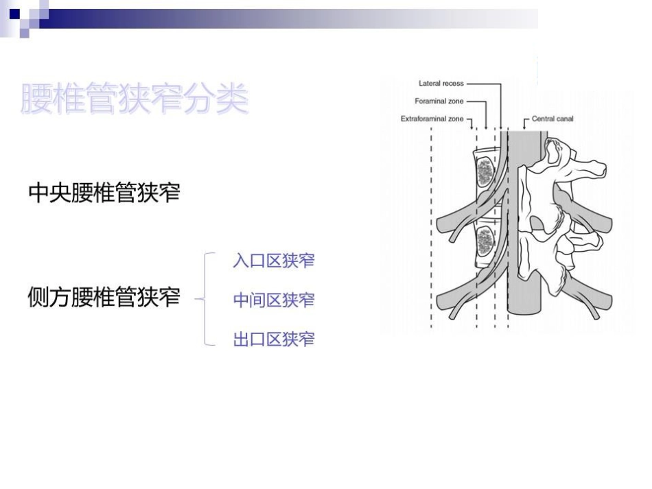 大通道椎间孔镜在老年腰椎管狭窄症患者中的应用和优势_第5页