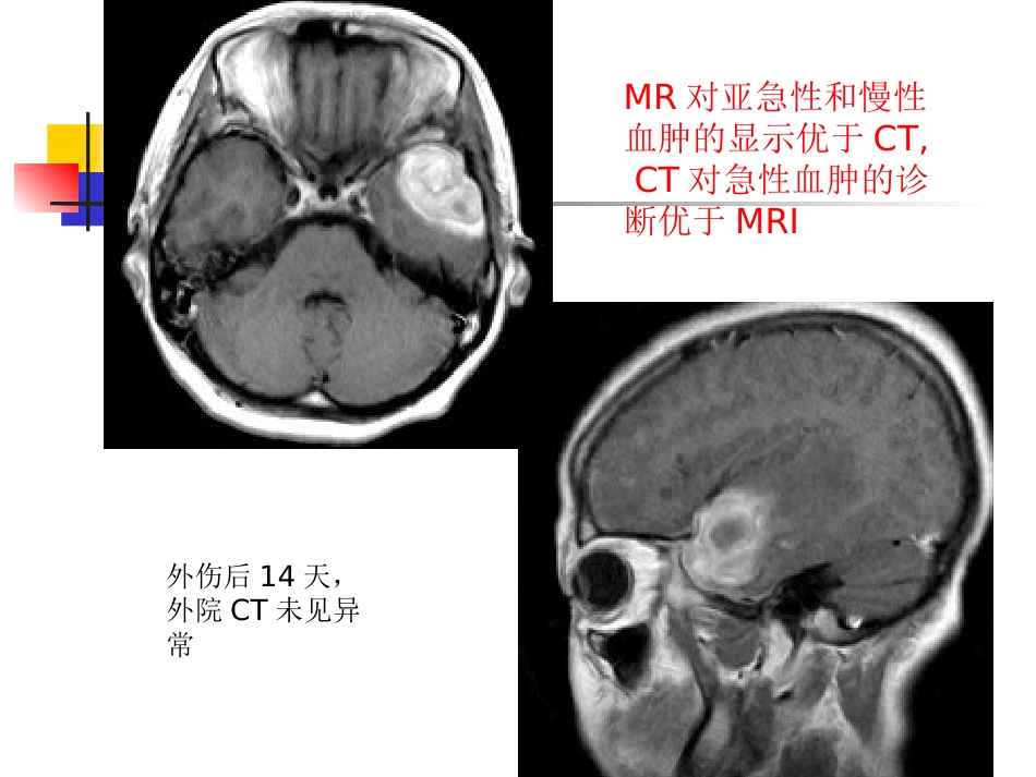 mri的临床应用中枢神经系统及骨骼软组织 ppt课件_第12页