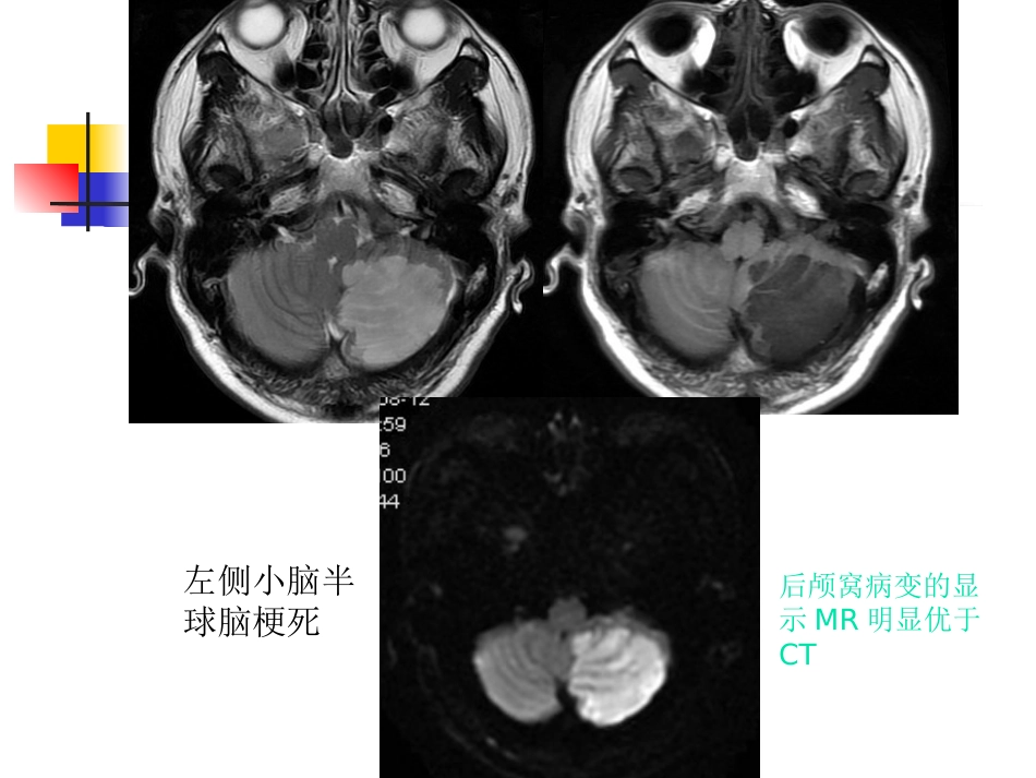 mri的临床应用中枢神经系统及骨骼软组织 ppt课件_第13页