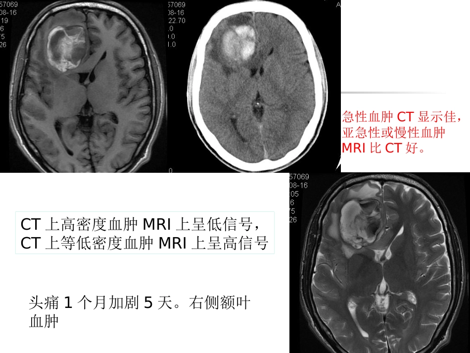 mri的临床应用中枢神经系统及骨骼软组织 ppt课件_第14页