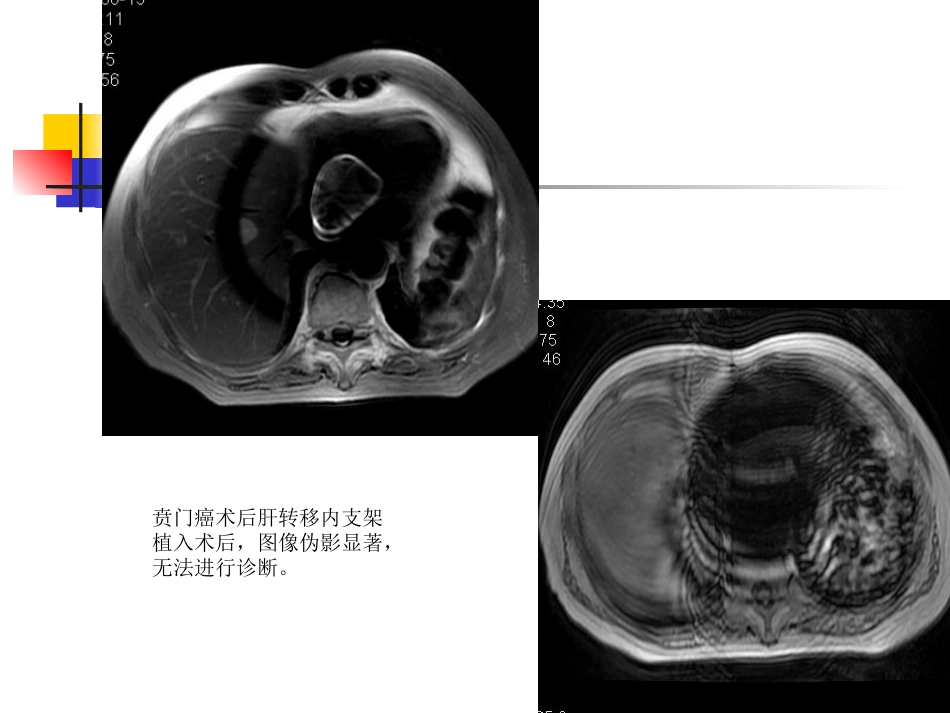mri的临床应用中枢神经系统及骨骼软组织 ppt课件_第8页